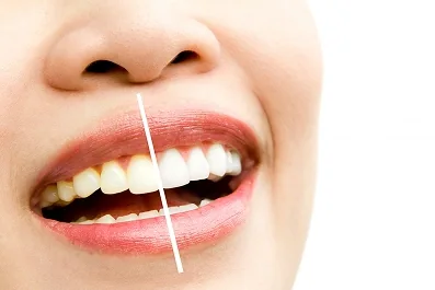 Comparação entre dentes amarelados e dentes clareados no mesmo sorriso
